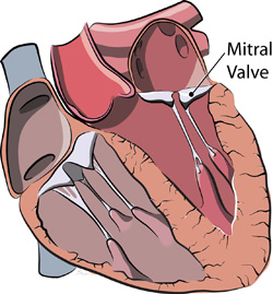 Mitral Valve Surgery Gives Better Recovery To Patients