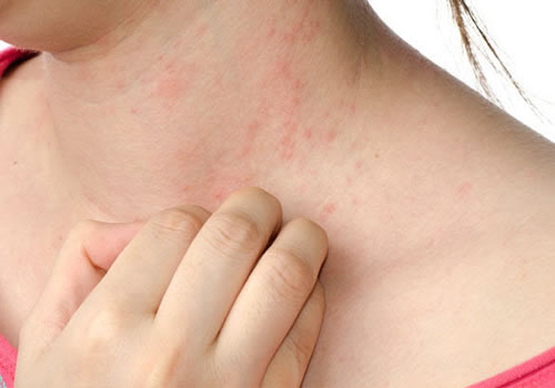 Indoor Allergens That Cause Eczema