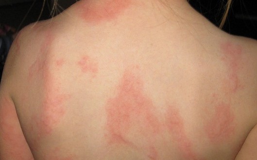 How To Clear Up That Eczema Rash